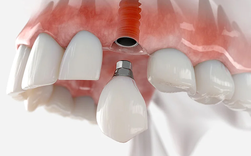 implant restoration