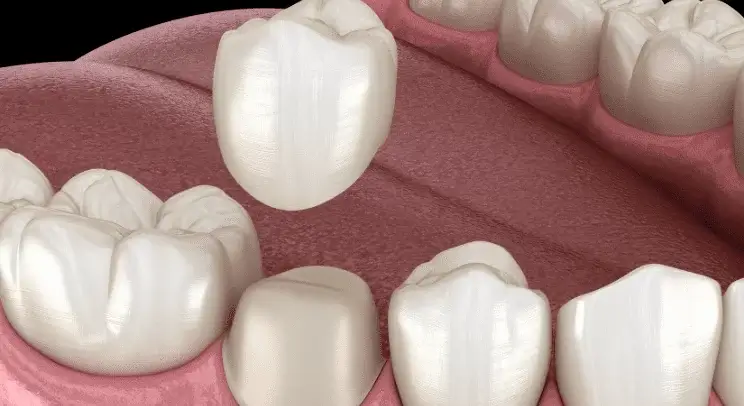 Emax Crowns & Veneers